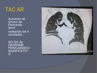 TAC AR
Aumento de
Grosor de
Pericardio
8mm
rodeando las 4
cavidades .

NO SG de
DERRAME
PERICARDICO
SIGNFICATIV
O
 