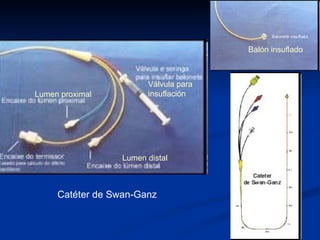 Catéter de Swan-Ganz Lumen distal Lumen proximal Válvula para  insuflación Balón insuflado 