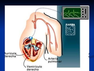 Catéter de Swan-Ganz 
