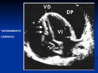 TAPONAMIENTO CARDIACO 