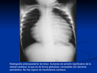 Radiografía anteroposterior de tórax: Aumento de tamaño significativo de la silueta cardíaca, la que es de forma globulosa, compatible con derrame pericárdico. No hay signos de insuficiencia cardíaca.  