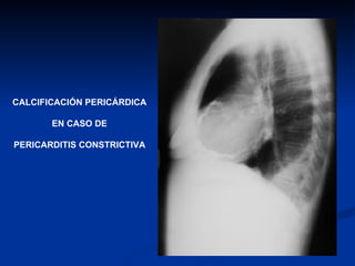 CALCIFICACIÓN PERICÁRDICA EN CASO DE PERICARDITIS CONSTRICTIVA 
