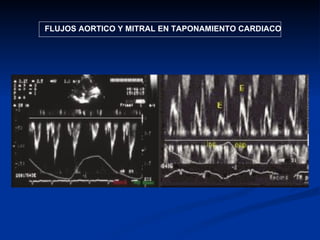 FLUJOS AORTICO Y MITRAL EN TAPONAMIENTO CARDIACO 
