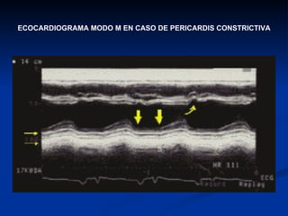 ECOCARDIOGRAMA MODO M EN CASO DE PERICARDIS CONSTRICTIVA 