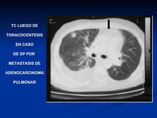 TC LUEGO DE TORACOCENTESIS EN CASO DE DP POR  METASTASIS DE ADENOCARCINOMA PULMONAR 