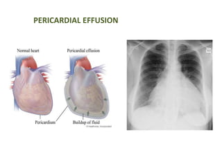 PERICARDIAL EFFUSION
 