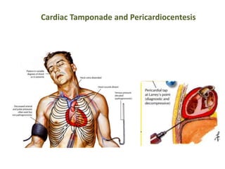 Cardiac Tamponade and Pericardiocentesis
 
