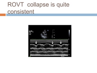 ROVT collapse is quite
consistent
 