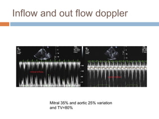 Inflow and out flow doppler
Mitral 35% and aortic 25% variation
and TV=80%
 