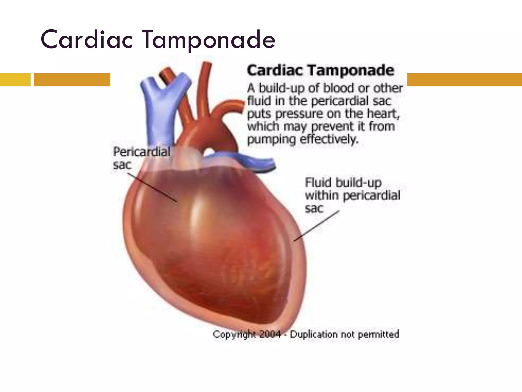 Cardiac Tamponade