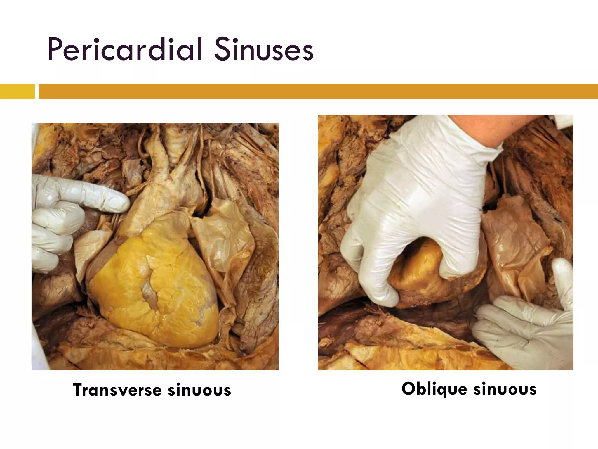 Pericardial Sinuses
Transverse sinuous Oblique sinuous