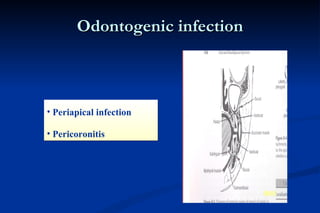 Odontogenic infection Periapical infection Pericoronitis 