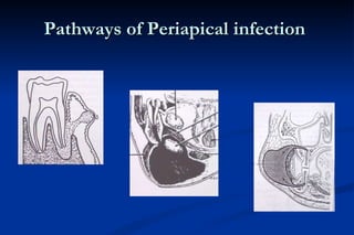 Pathways of Periapical infection  