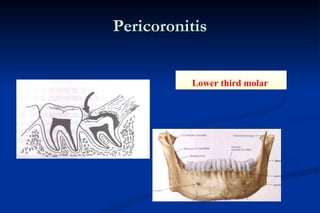 Pericoronitis Lower third molar  