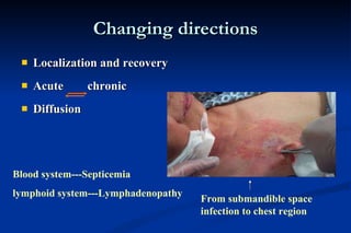 Changing directions Localization and recovery Acute  chronic Diffusion Blood system---Septicemia lymphoid system---Lymphadenopathy From submandible space infection to chest region 