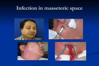 Infection in masseteric space 