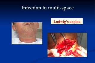 Infection in multi-space Ludwig’s angina 