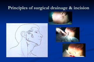 Principles of surgical drainage & incision 