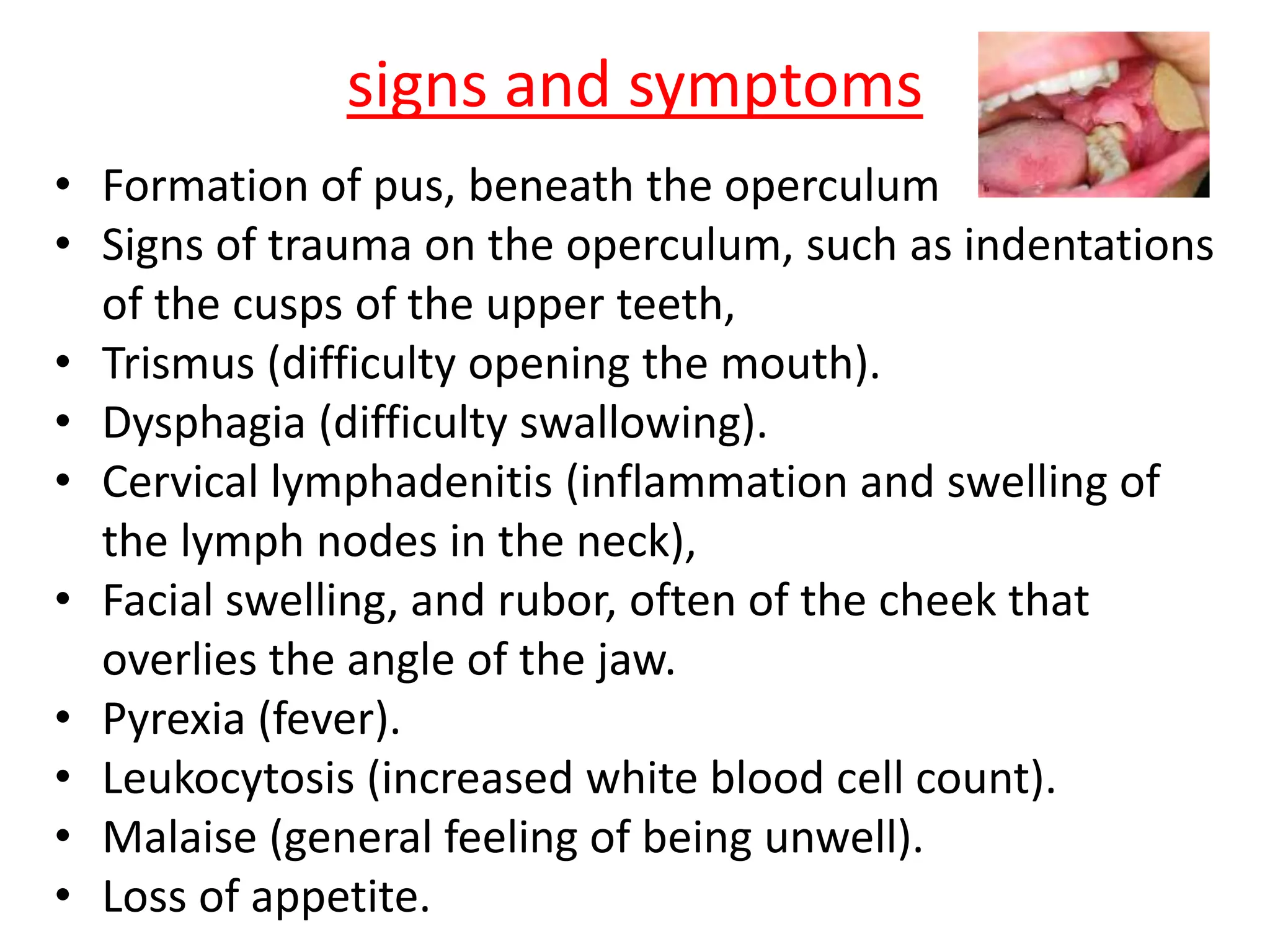 Pericoronitis PPT