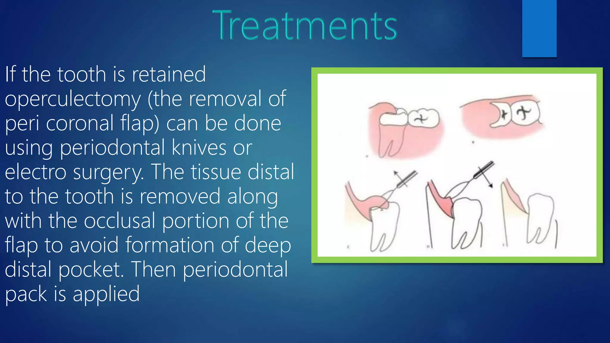 Pericoronitis PPT