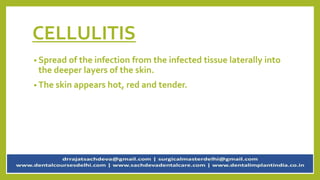CELLULITIS
• Spread of the infection from the infected tissue laterally into
the deeper layers of the skin.
• The skin appears hot, red and tender.
 