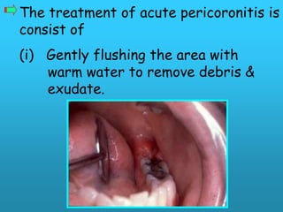 The treatment of acute pericoronitis is
consist of
(i) Gently flushing the area with
    warm water to remove debris &
    exudate.
 