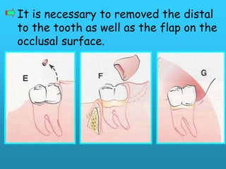 It is necessary to removed the distal
to the tooth as well as the flap on the
occlusal surface.
 