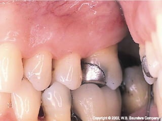 Pericoronitis  