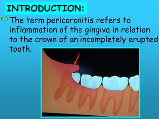 INTRODUCTION:
The term pericoronitis refers to
inflammation of the gingiva in relation
to the crown of an incompletely erupted
tooth.
 