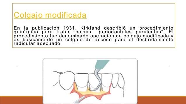 Tratamientos periodontales quirúrgicos.