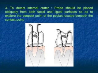 3. To detect internal crater : Probe should be placed
obliquely from both facial and ligual surfaces so as to
explore the deepest point of the pocket located beneath the
contact point.
 