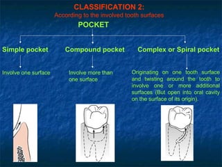 CLASSIFICATION 2:
According to the involved tooth surfaces
Involve one surface Involve more than
one surface
Originating on one tooth surface
and twisting around the tooth to
involve one or more additional
surfaces (But open into oral cavity
on the surface of its origin).
POCKET
Simple pocket Compound pocket Complex or Spiral pocket
 