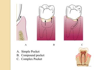A B C
A. Simple Pocket
B. Compound pocket
C. Complex Pocket
 