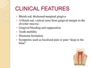 CLINICAL FEATURES
 Bluish red, thickened marginal gingiva
 A bluish red, vertical zone from gingival margin to the
alveolar mucosa
 Gingival bleeding and suppuration
 Tooth mobility
 Diastema formation
 Symptoms such as localized pain or pain “deep in the
bone”
 