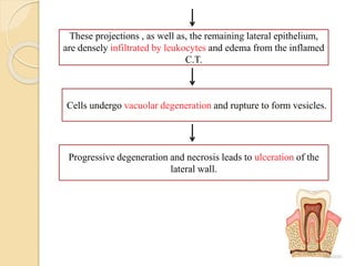 These projections , as well as, the remaining lateral epithelium,
are densely infiltrated by leukocytes and edema from the inflamed
C.T.
Cells undergo vacuolar degeneration and rupture to form vesicles.
Progressive degeneration and necrosis leads to ulceration of the
lateral wall.
 