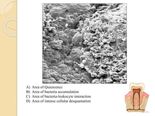 A) Area of Quiescence
B) Area of bacteria accumulation
C) Area of bacteria-leukocyte interaction
D) Area of intense cellular desquamation
 