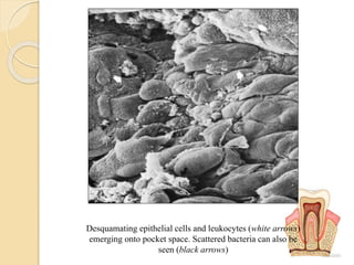 Desquamating epithelial cells and leukocytes (white arrows)
emerging onto pocket space. Scattered bacteria can also be
seen (black arrows)
 