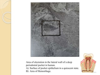 Area of ulceration in the lateral wall of a deep
periodontal pocket in human.
A) Surface of pocket epithelium in a quiescent state.
B) Area of Hemorrhage.
 