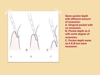 Same pocket depth
with different amount
of recession.
A. Gingival pocket with
no recession.
B. Pocket depth as A
with some degree of
recession.
C. Pocket depth same
as A & B but more
recession.
A B C
 