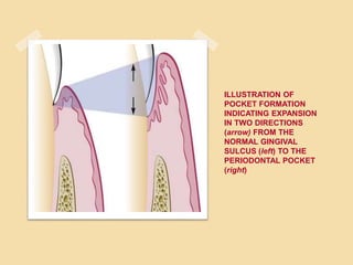 ILLUSTRATION OF
POCKET FORMATION
INDICATING EXPANSION
IN TWO DIRECTIONS
(arrow) FROM THE
NORMAL GINGIVAL
SULCUS (left) TO THE
PERIODONTAL POCKET
(right)
 