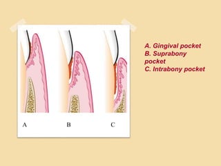 A. Gingival pocket
B. Suprabony
pocket
C. Intrabony pocket
A B C
 