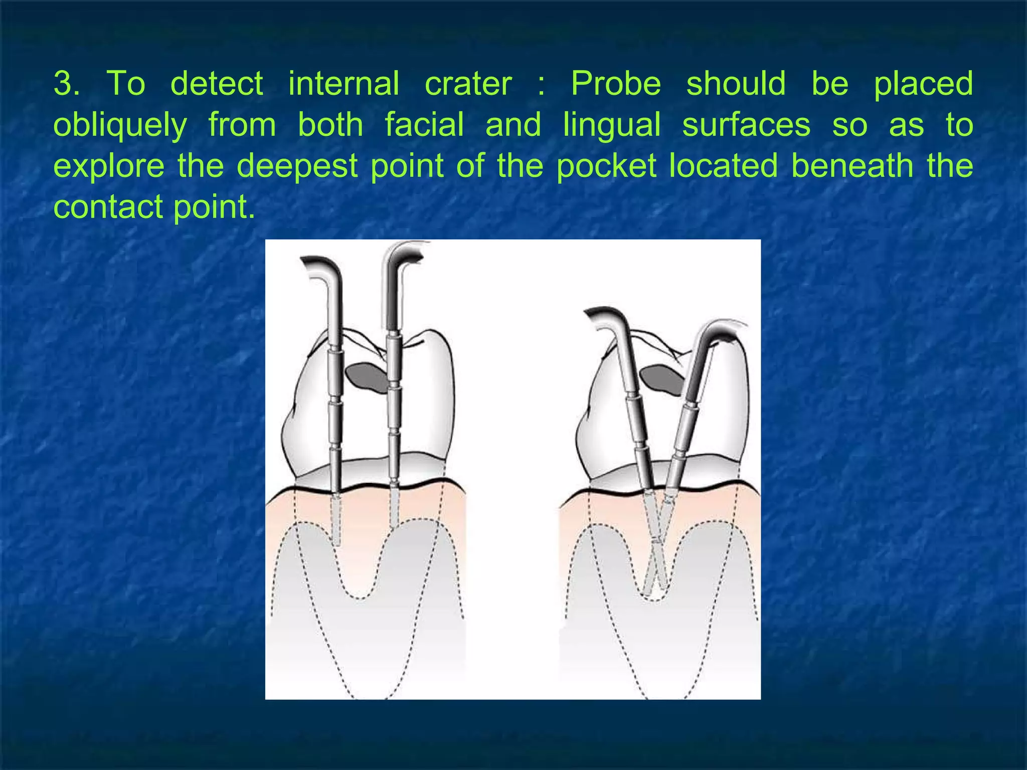 3. To detect internal crater : Probe should be placed obliquely from both facial and lingual surfaces so as to explore the deepest point of the pocket located beneath the contact point. 