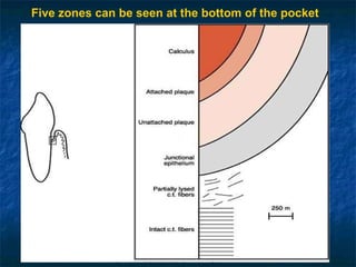 Five zones can be seen at the bottom of the pocket Also known as Plaque free zone 
