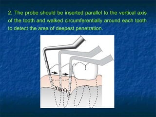 2. The probe should be inserted parallel to the vertical axis of the tooth and walked circumferentially around each tooth to detect the area of deepest penetration. 