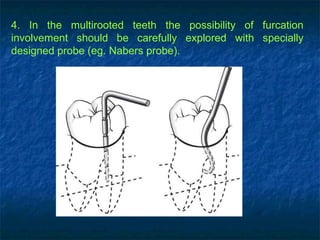 4. In the multirooted teeth the possibility of furcation involvement should be carefully explored with specially designed probe (eg. Nabers probe). 