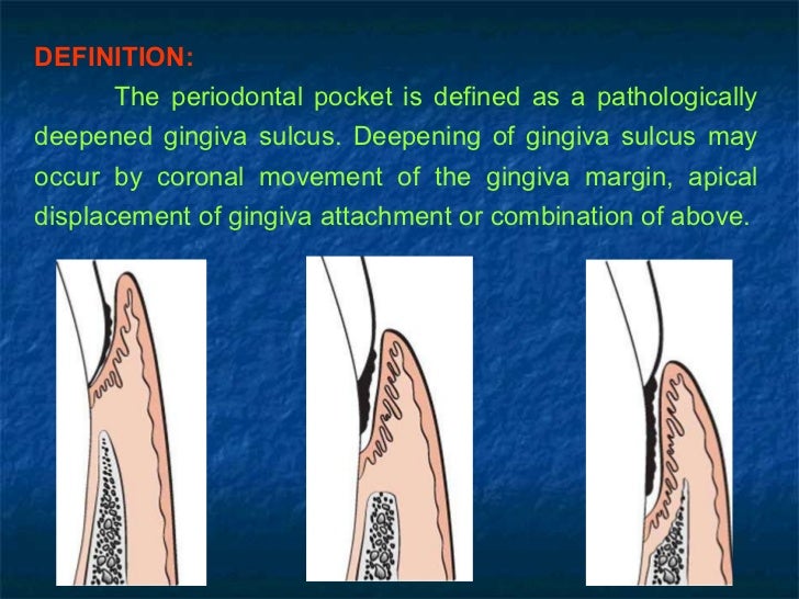peridontal pocket