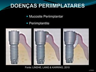 DOENÇAS PERIIMPLATARES
 Mucosite Periimplantar
 Periimplantite
Fonte: LINDHE, LANG & KARRING, 2010
L.P.M.C.
 