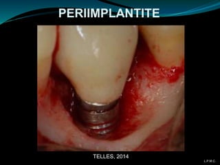 PERIIMPLANTITE
TELLES, 2014
L.P.M.C.
 