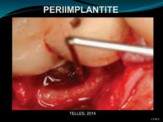 PERIIMPLANTITE
TELLES, 2014
L.P.M.C.
 