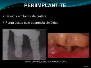  Defeitos em forma de cratera
 Perda óssea com aparência simétrica
PERIIMPLANTITE
L.P.M.C.
Fonte: LINDHE, LANG & KARRING, 2010
 